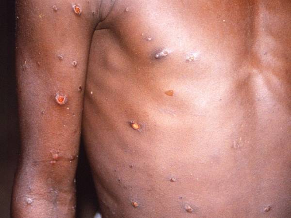 La viruela del mono se caracteriza por lesiones en la piel y también provoca fiebre, tos y dolores musculares.