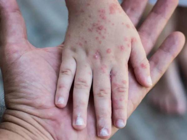 La alerta indica que los menores de cinco años, específicamente los menores de un año son los más vulnerables ante la enfermedad.