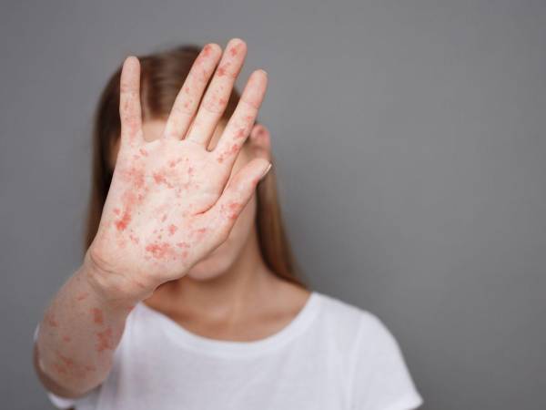 En el país se han registrado 44 focos y 1,596 casos confirmados de Sarampión en lo que va del año, según los Centros para el Control y la Prevención de Enfermedades (CDC) de Estados Unidos. Esto se sabe del brote que mantienen en cuarentena a Carolina del Norte.