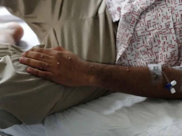 El Ministerio de Salud recomendó evitar el contacto físico estrecho, con personas que presenten lesiones compatibles con la enfermedad o que tengan un diagnóstico confirmado.