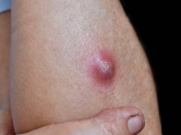 La mosca deja sus huevecillos en heridas abiertas y estos eclosionan en larvas días después que se comen el tejido vivo de las personas.