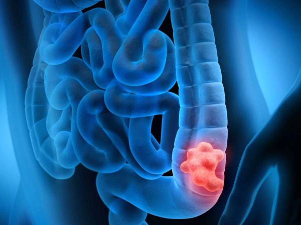 Todo empieza con una pequeña acumulación de células que se forma en el revestimiento del colon o el recto, esta puede crecer durante una década antes de transformarse en tumor.