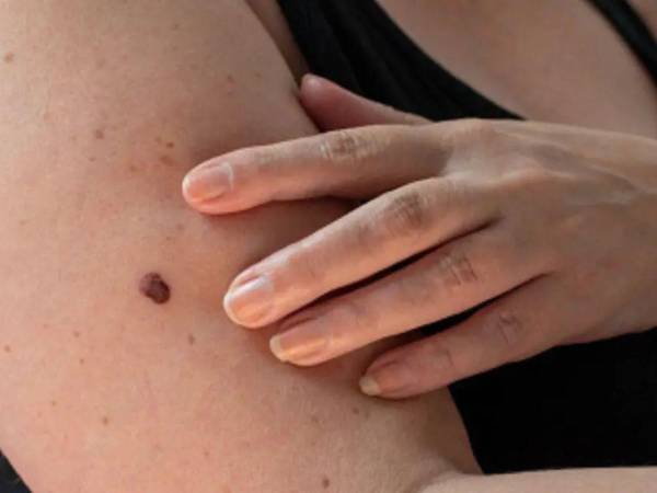 El cáncer de piel es uno de los más comunes, debido a la exposición prolongada a los rayos del sol.