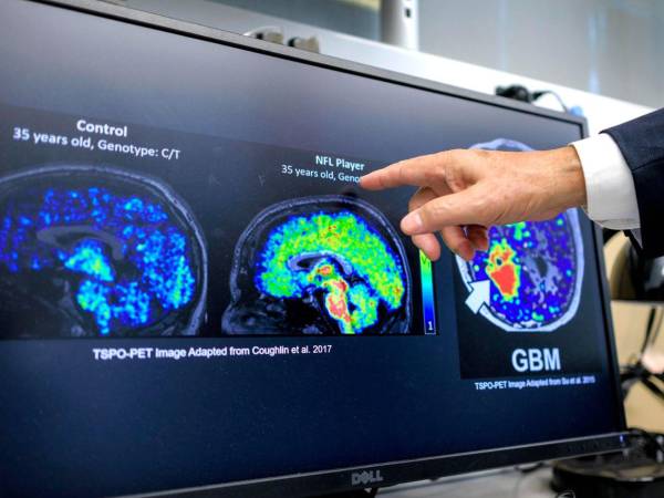 Los niveles altos de un biomarcador clave de la inflamación cerebral podría indicar desde temprano que una persona desarrollará alzhéimer.