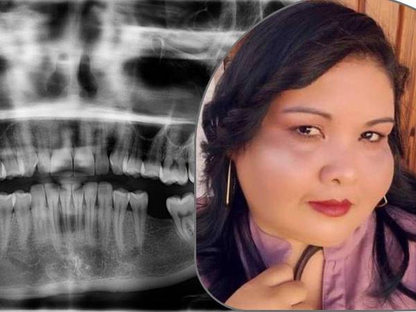 Meningitis bacteriana fue el diagnóstico de los médicos del Hospital del Sur en torno a la muerte de Cristina Elizabeth Lagos, quien acudió al Hospital General del Sur debido a un molesto dolor de muela. A continuación le explicamos de qué trata esta enfermedad y cómo prevenirla.