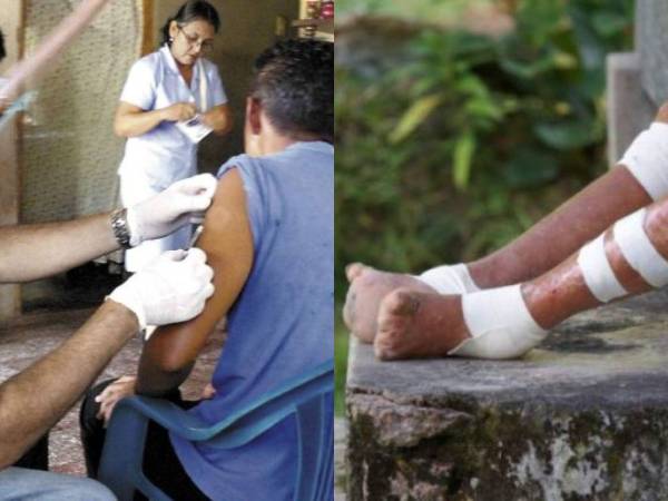 Una de las enfermedades más antiguas y temidas se siguen detectando en el territorio nacional. En los últimos días, las autoridades de la región sanitaria de la zona sur reportaron una serie de casos de lepra en Choluteca, zona sur de Honduras. En ese sentido, a continuación le presentamos los síntomas y cómo protegerse de esta enfermedad.