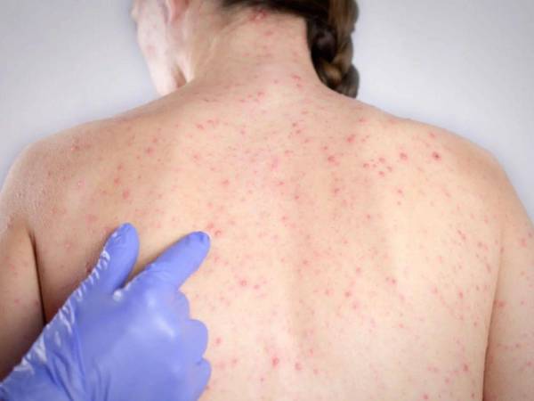 Las autoridades sanitarias recomiendan a la población que al presentar síntomas como fiebre alta, tos seca, erupción de manchas rojas en la piel acudan a los establecimientos de salud.