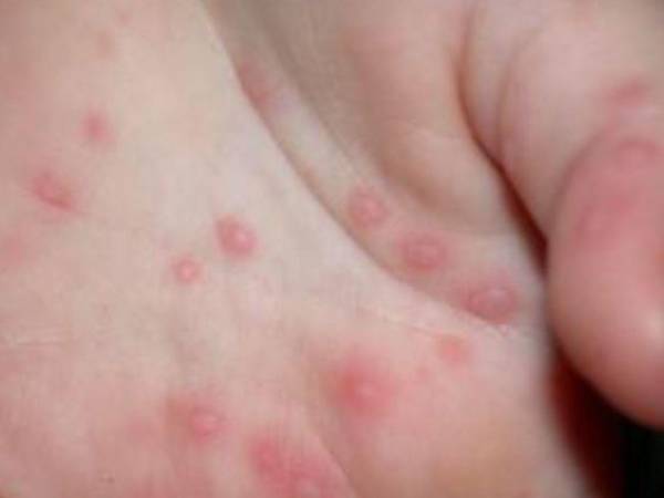 El virus está presente en secreciones nasales, saliva, mucosidad y líquido de las ampollas.