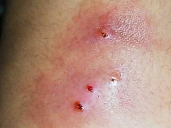 El paciente, quien ya había recibido atención médica, dijo regresar de un viaje de El Salvador. Actualmente, ese país solo ha oficializado 4 casos de gusano barrenador en humanos.