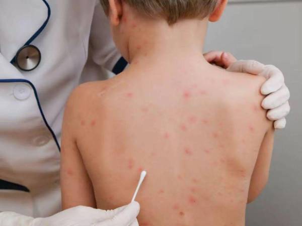 Actualmente las autoridades de la Secretaría de Salud confirman 12 casos de sarampión, de los cuales cuatro son menores de edad.