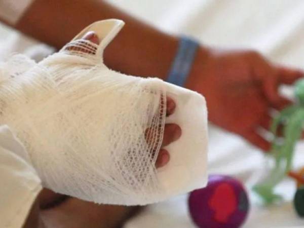 Las manos son la parte más afectada en los niños quemados.