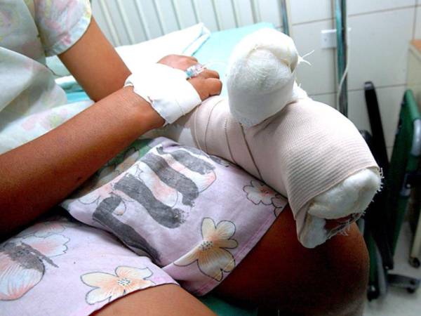 Según las autoridades de distintos centros médicos, el uso de la pólvora pesada fue un factor determinante para el ingreso e incluso amputación parcial en las manos de 5 menores de edad.