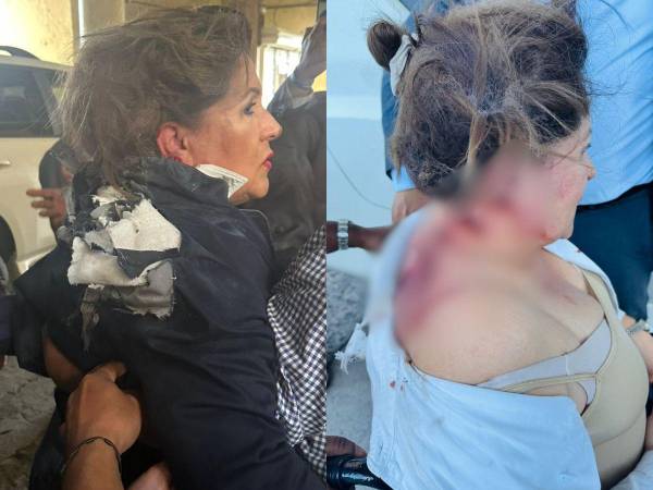 Acostada en una camilla, a la espera de los resultados médicos y de una segunda evaluación, se encuentra la diputada nacionalista Gladis López, quien fue atacada con un artefacto explosivo cuando se disponía a ingresar al Congreso Nacional (CN). Esto dijo sobre su estado de salud: