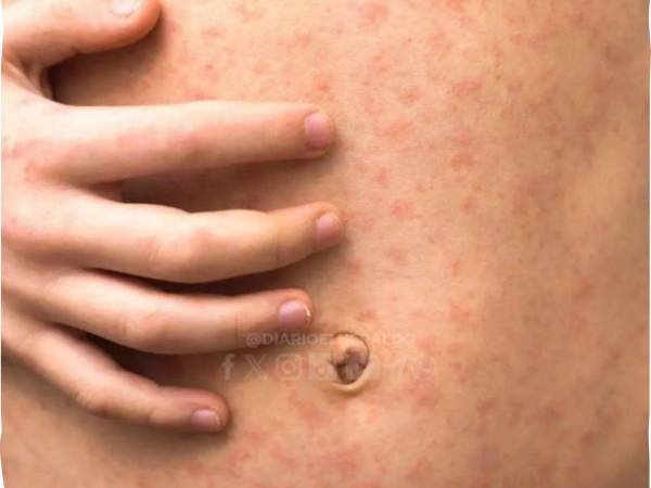 Las autoridades de Salud informaron que los sospechosos están bajo vigilancia médica.