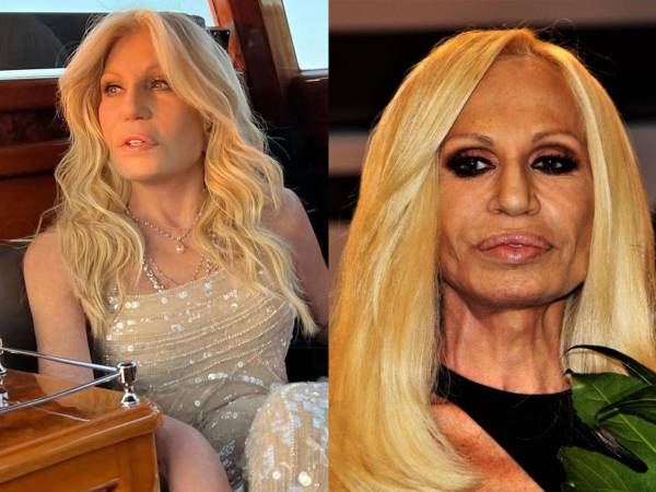 Donatella Versace, de 70 años, reaparece con un nuevo rostro. Un experto analiza si la diseñadora ha revertido antiguos retoques estéticos o si se trata del efecto del envejecimiento natural.