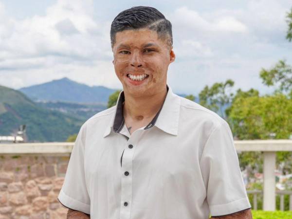 “El Bombero” fue víctima de un grave accidente mientras combatía un incendio forestal en La Montañita en 2018.