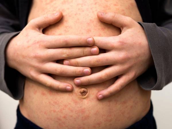 Las edades de las personas sospechosas de sarampión rondan 14, 32, 22 y 6 meses.