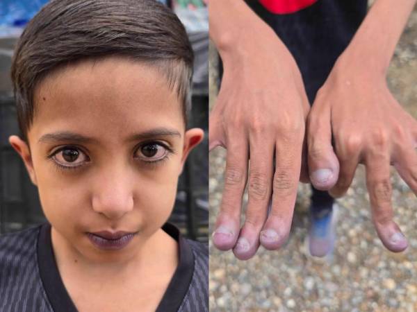 Josué Nehemías Cruz Cruz, un niño hondureño de 11 años, recibirá atención médica especializada en El Salvador luego de que su caso llegara hasta las autoridades de ese país tras una extraña condición. Aquí le explicamos su caso: