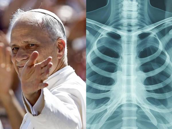 De forma sorpresiva, tras el rezo del Ángelus, el papa León XIV anunció que deberá someterse a una cirugía por un nódulo en uno de sus pulmones. ¿En qué consiste este diagnóstico y qué se sabe sobre este tipo de lesiones?
