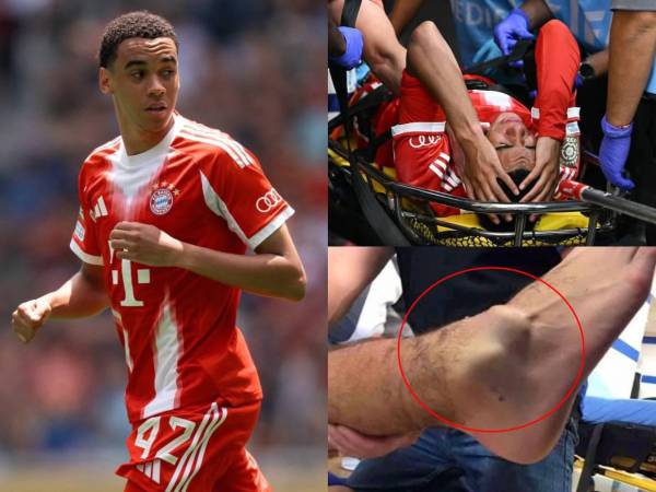 Jamal Musiala, centrocampista del Bayern Múnich, salió lesionado en los cuartos de final del Mundial de Clubes ante el PSG y ya se conoce su diagnóstico oficial. Este tiempo estará de baja.