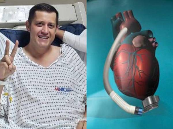 ¿Qué es el corazón artificial de L10.5 millones que necesita diputado de Libre para vivir? El congresista Octavio Morales requiere de un artefacto para salir adelante, algo que es sumamente caro.
