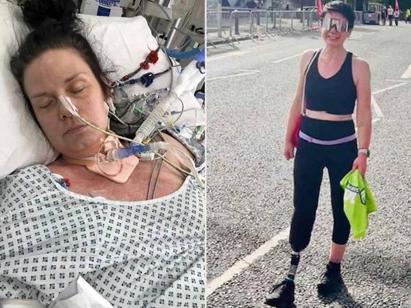 Como consecuencia de la enfermedad, la mujer también quedó con una función pulmonar y renal reducida.