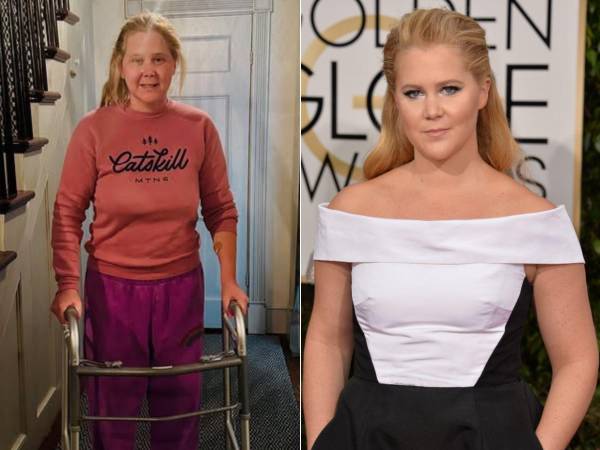 La actriz y comediante Amy Schumer compartió en su cuenta de Instagram una fotografía en la que aparece utilizando un andador, anunciando que el viernes fue intervenida quirúrgicamente de la columna vertebral.