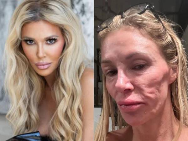 La exparticipante de The Real Housewives of Beverly Hills confirmó que recibió un diagnóstico oficial para la condición que ha afectado su rostro desde 2023, aunque no reveló de qué se trata.