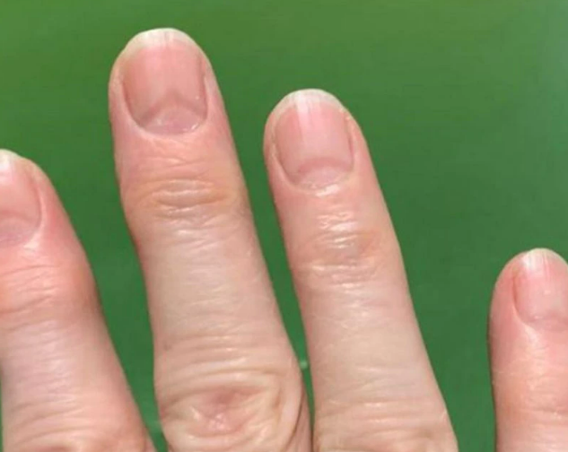 Mareos, dedos covid y caída de cabello: los extraños nuevos síntomas del covid-19