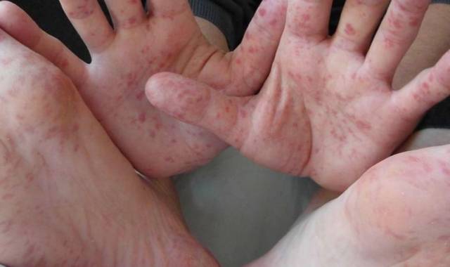 El sarpullido en manos, pies y boca es el más característico en el virus de coxsackie.