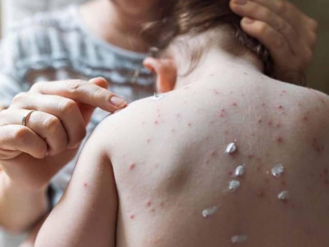 Microbiólogos piden a los hondureños estar alerta ante Viruela del Mono