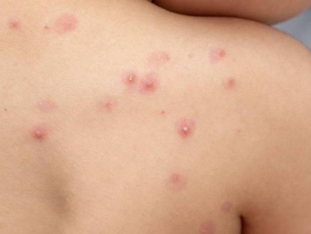 ¿Cuál es la población hondureña más vulnerable ante la viruela del mono y cómo se transmite?