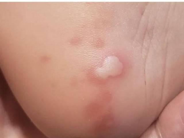 Hasta 21 días de hospitalización a contagiados: las medidas que adoptará Honduras tras primer caso de viruela del mono