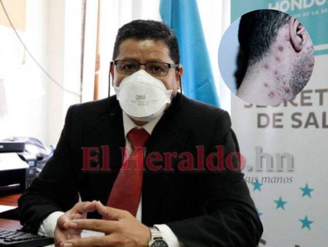 Extranjero contagió a primer hondureño detectado con viruela del mono