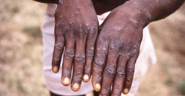 ¿La viruela del mono es un virus nuevo en el mundo?