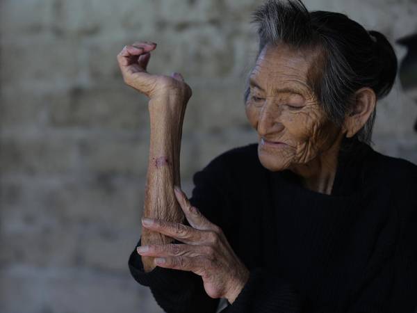 El gusano barrenador no solo ha afectado a casi 700 personas en Centroamérica, sino que ya deja fallecidos. Honduras es el país con más registros de gusano barrenador en personas.