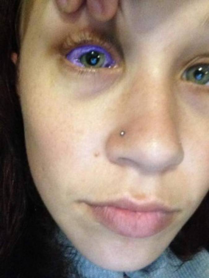 Quería verse diferente, se tatuó los ojos y sufrió las terribles consecuencias