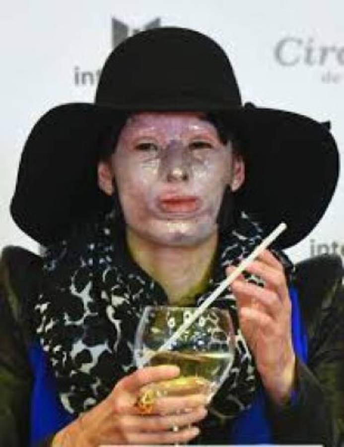 'No siento odio', dice víctima de ataque con ácido en Colombia