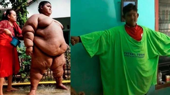 El impactante cambio físico de Arya Permana, el niño más gordo del mundo