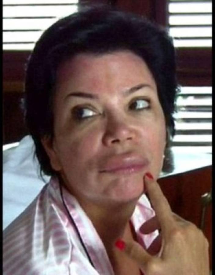 Kris Jenner apareció en TV con el labio desfigurado
