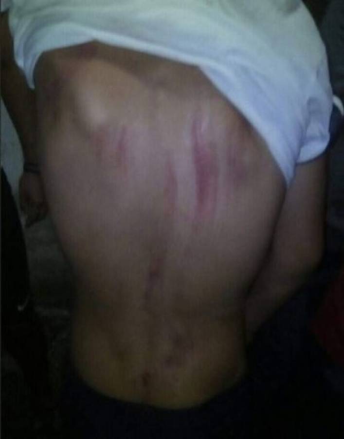 Uno de los jóvenes heridos muestra las quemaduras que le dejó el rayo. (Foto: RedInformativaH/ El Heraldo Honduras, Noticias de Honduras)
