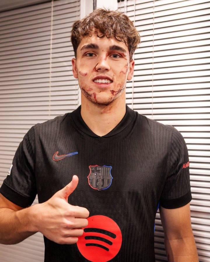 Fuertes imágenes: así quedó la cara de Pau Cubarsí tras recibir patada en Champions League Fuertes imágenes: así quedó la cara de Pau Cubarsí tras recibir patada en Champions League