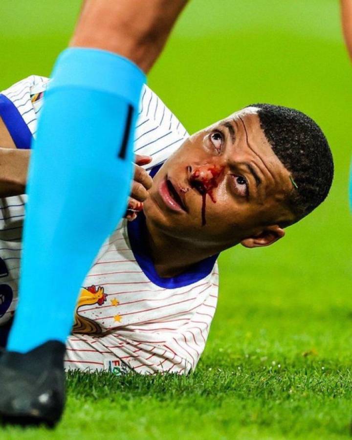 Kylian Mbappé se fracturó la nariz en el Austria-Francia: ¿Se pierde el resto de la Euro?