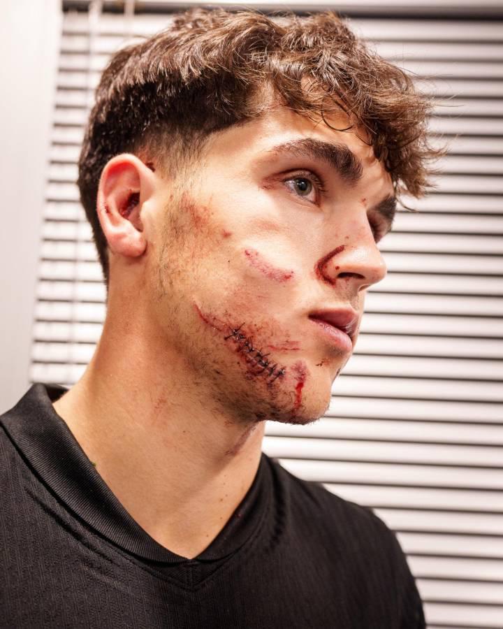 Fuertes imágenes: así quedó la cara de Pau Cubarsí tras recibir patada en Champions League Fuertes imágenes: así quedó la cara de Pau Cubarsí tras recibir patada en Champions League