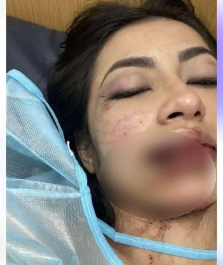 La imagen muestra la lamentable condición en la que quedó la jovencita tras ser agredida por su pareja.