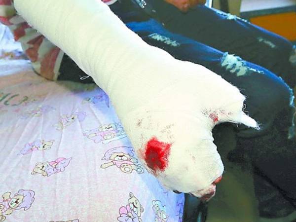 Los menores quemados están siendo atendidos en el Centro Hondureño para el Niño Quemado (Ceniq), donde reciben atención especializada e intentan reducir las secuelas que les quedan.