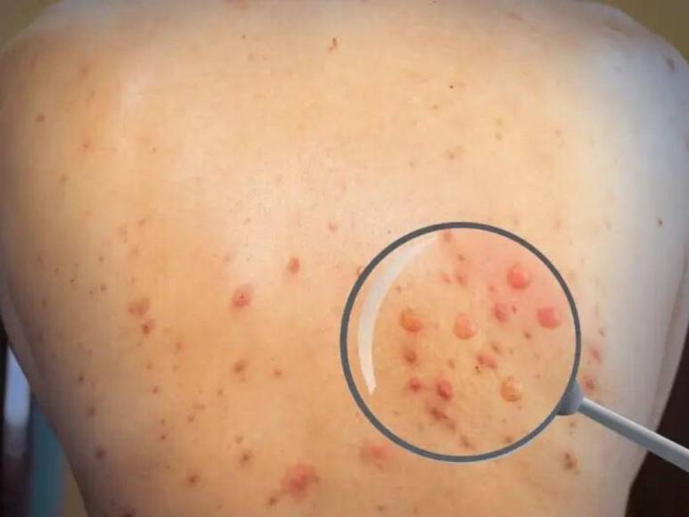 ¿Cómo se contagia la viruela del mono y cuáles son los síntomas para detectarla?