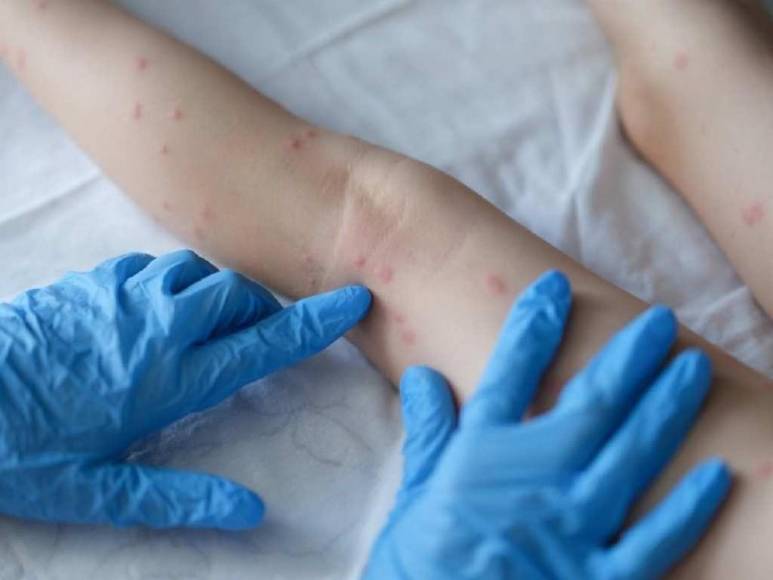 Esto debe saber para prevenir la viruela del mono y aprender a identificar la enfermedad