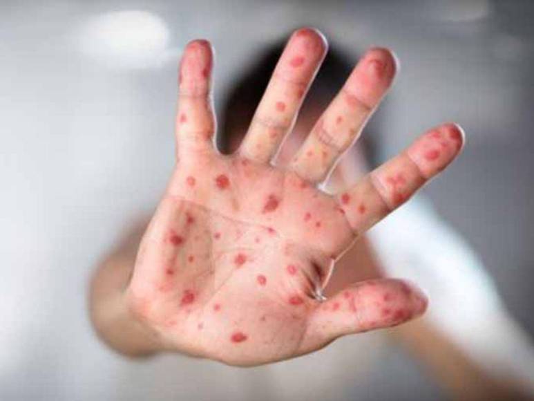 ¿Cómo protegerse de la viruela del mono? Aquí las medidas que debes tomar