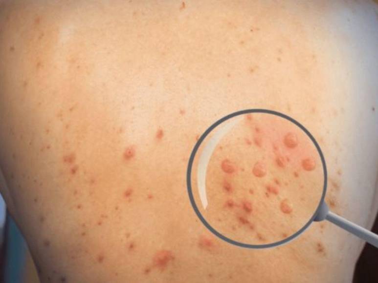 Estas son las diferencias entre viruela del mono y varicela